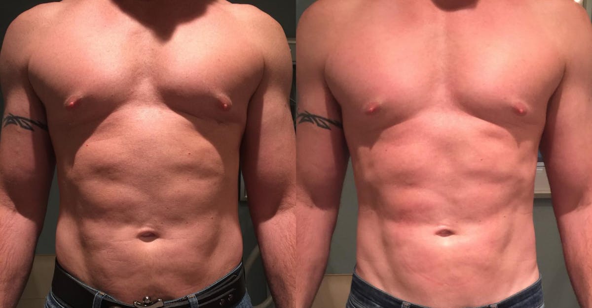 EMSculpt Before & After Gallery - Patient 404804 - Image 1