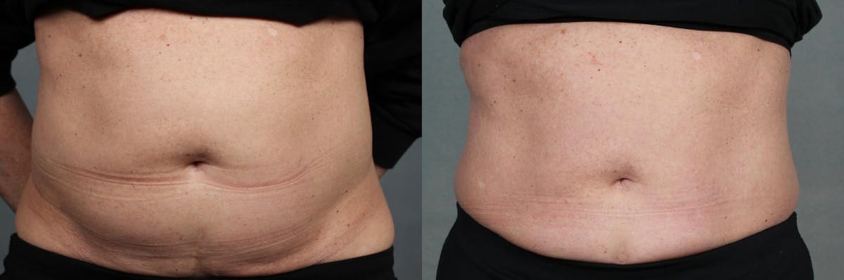 EMSculpt Before & After Gallery - Patient 393258 - Image 1