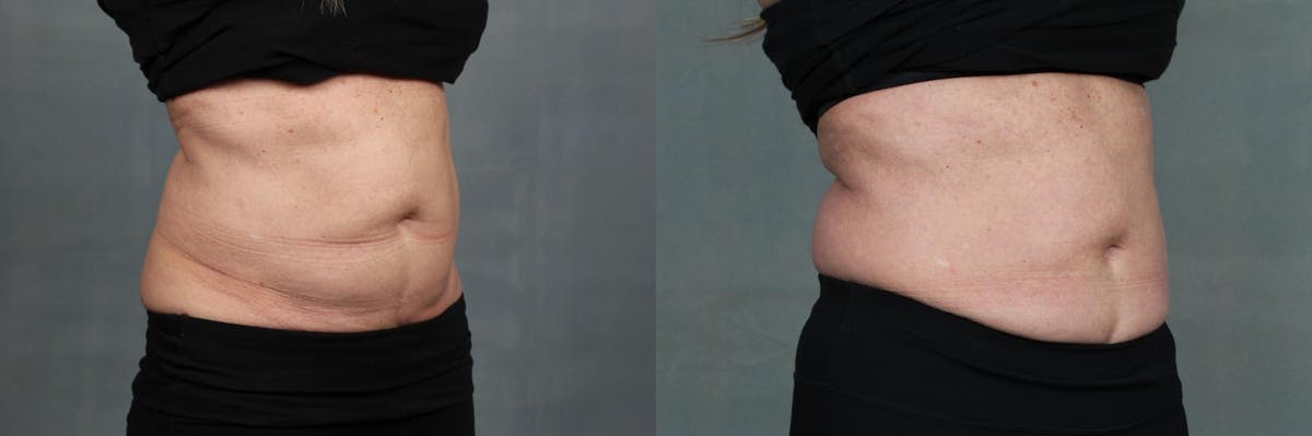 EMSculpt Before & After Gallery - Patient 393258 - Image 2