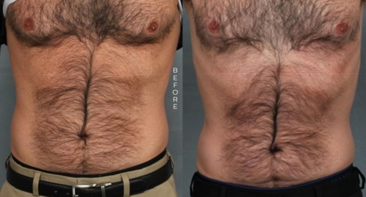 EMSculpt Before & After Gallery - Patient 139597 - Image 1