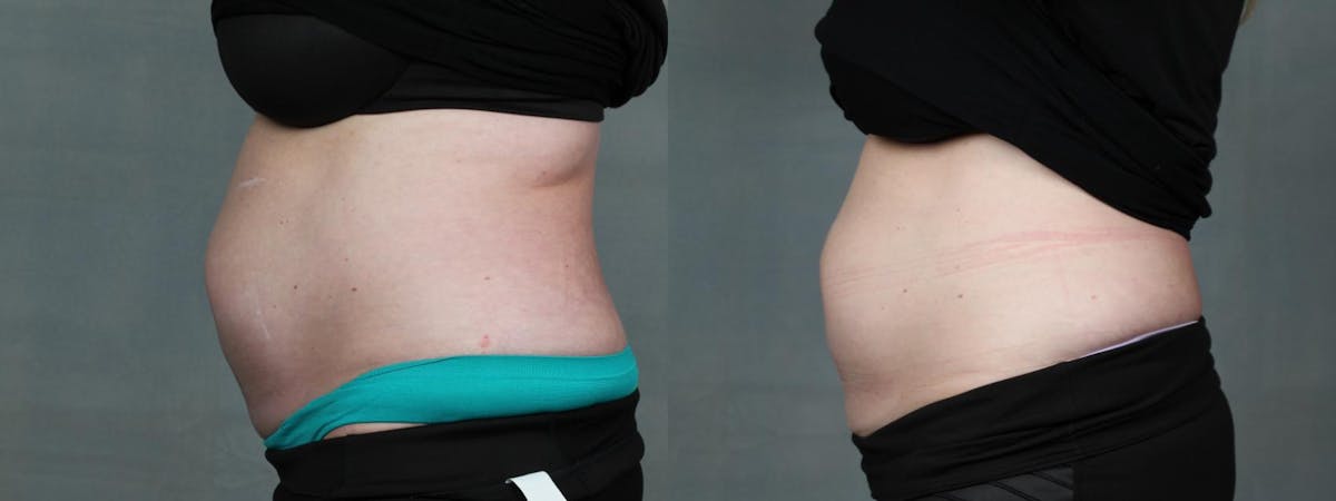 TruSculpt iD Before & After Gallery - Patient 329527 - Image 1