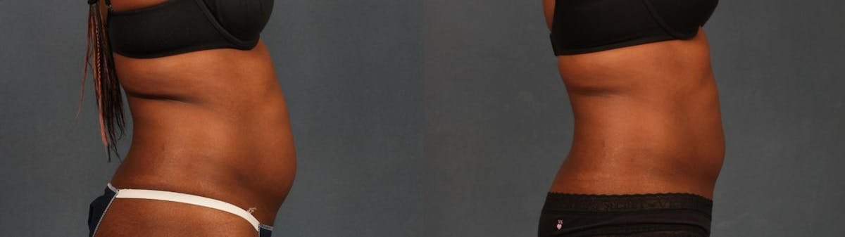 TruSculpt iD Before & After Gallery - Patient 399065 - Image 1