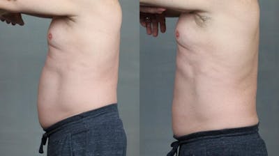 TruSculpt iD Before & After Gallery - Patient 307014 - Image 1