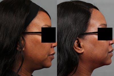 TruSculpt iD Before & After Gallery - Patient 670898 - Image 1