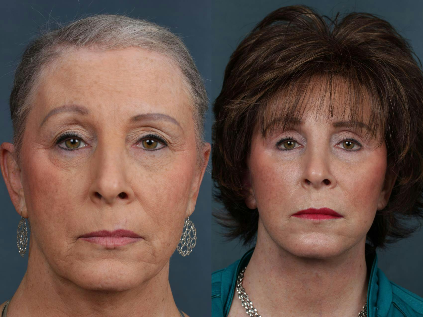 Eyelid Surgery Before & After Gallery - Patient 180269 - Image 1