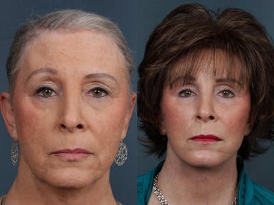 Eyelid Surgery Before & After Gallery - Patient 180269 - Image 1
