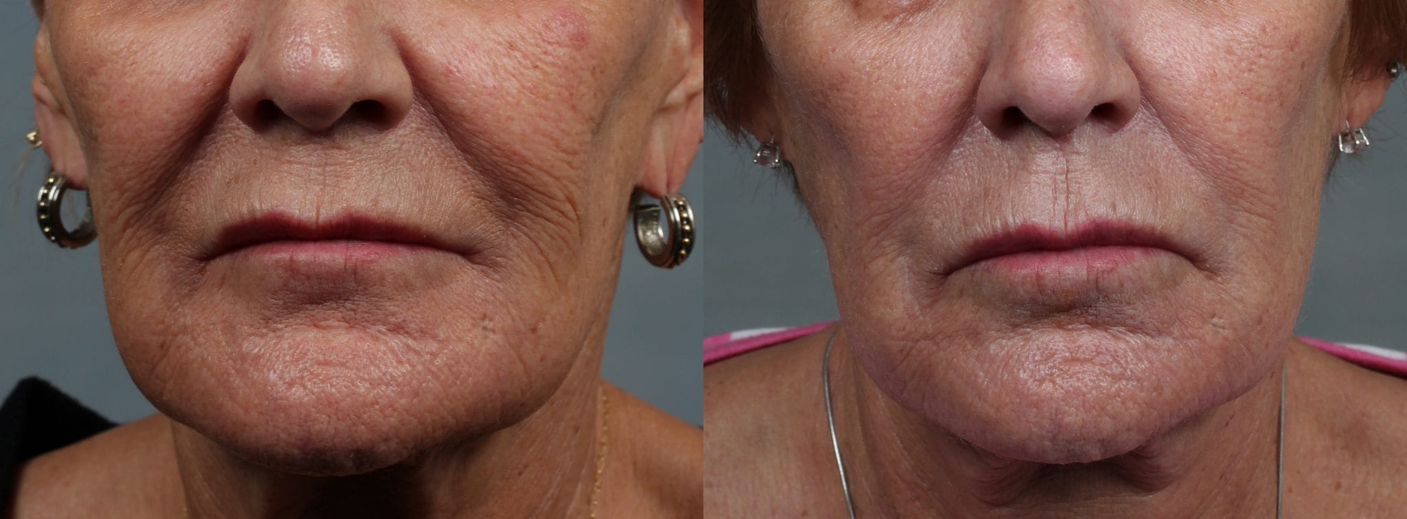 microneedling results
