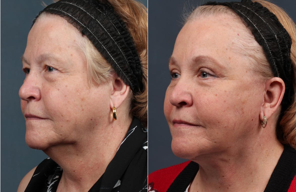 Facelift Before & After Gallery - Patient 127648 - Image 1