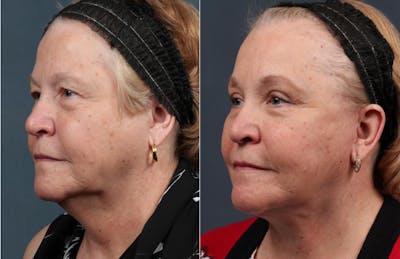 Facelift Before & After Gallery - Patient 127648 - Image 1