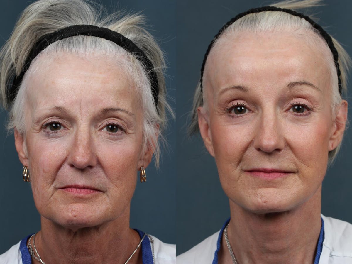Facelift Before & After Gallery - Patient 184230 - Image 1