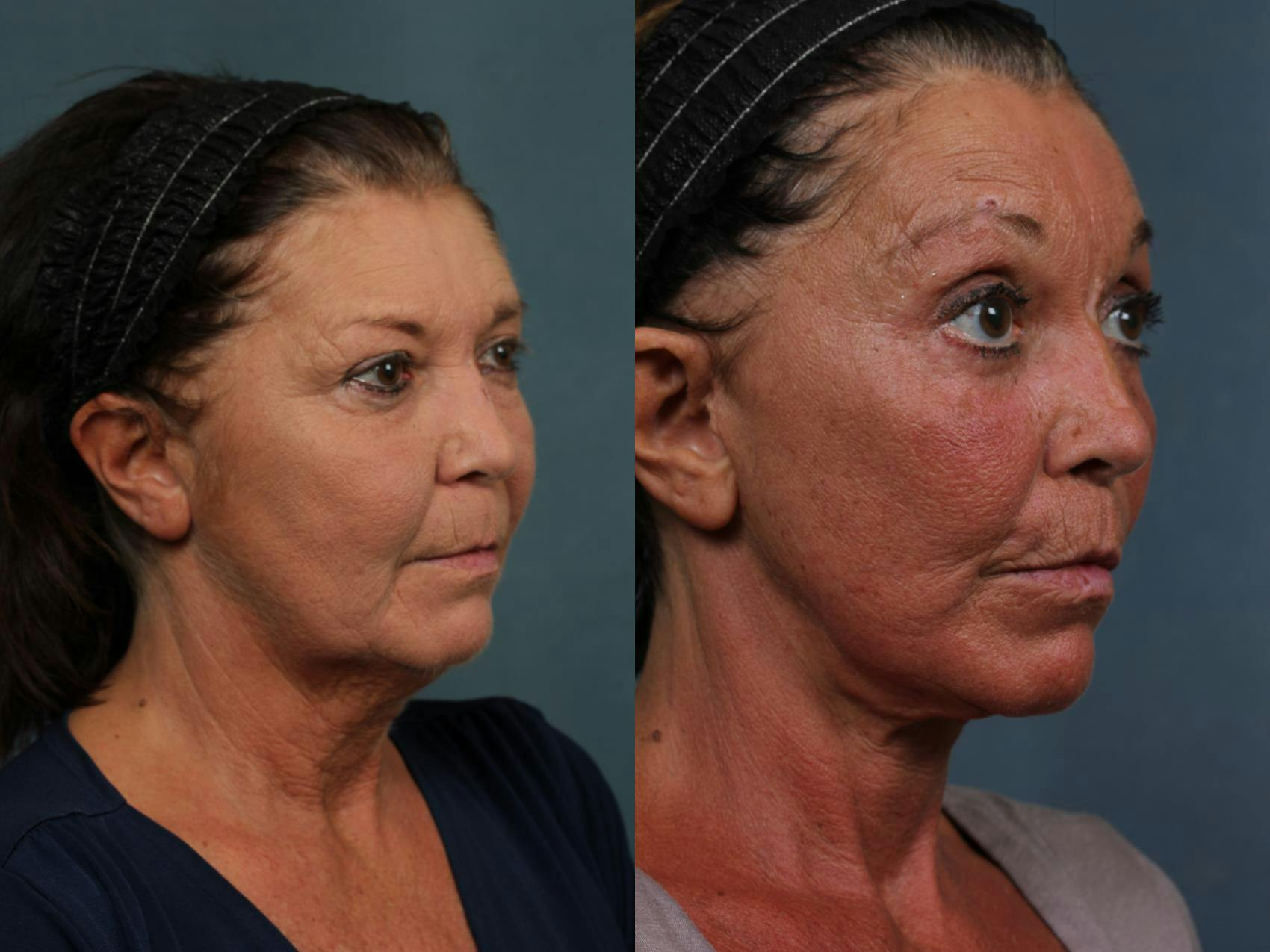 Facelift Before & After Gallery - Patient 403537 - Image 3
