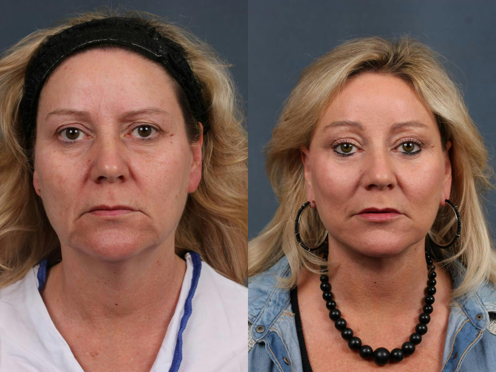 Facelift Before & After Gallery - Patient 196252 - Image 1