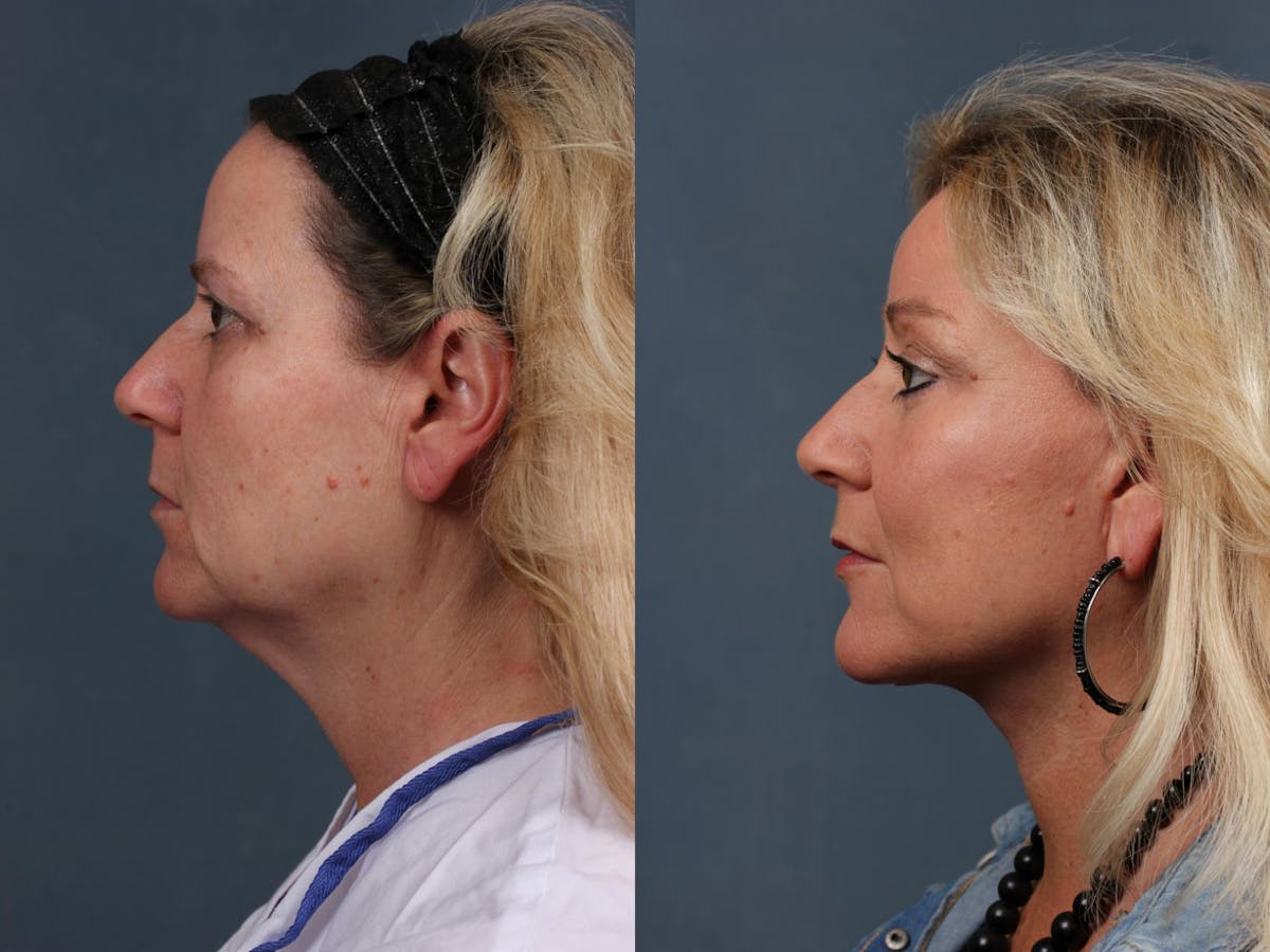 Facelift Before & After Gallery - Patient 196252 - Image 2