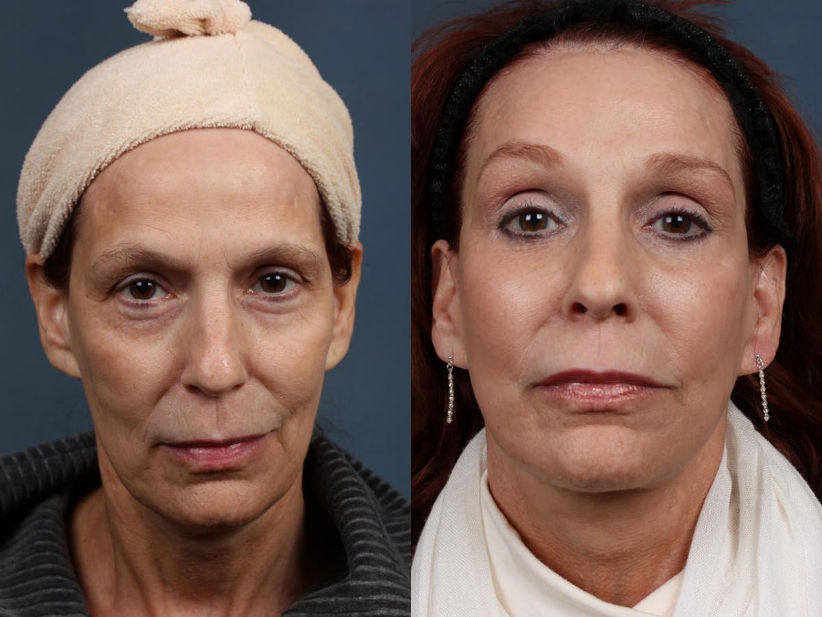 Facelift Before & After Gallery - Patient 390456 - Image 1