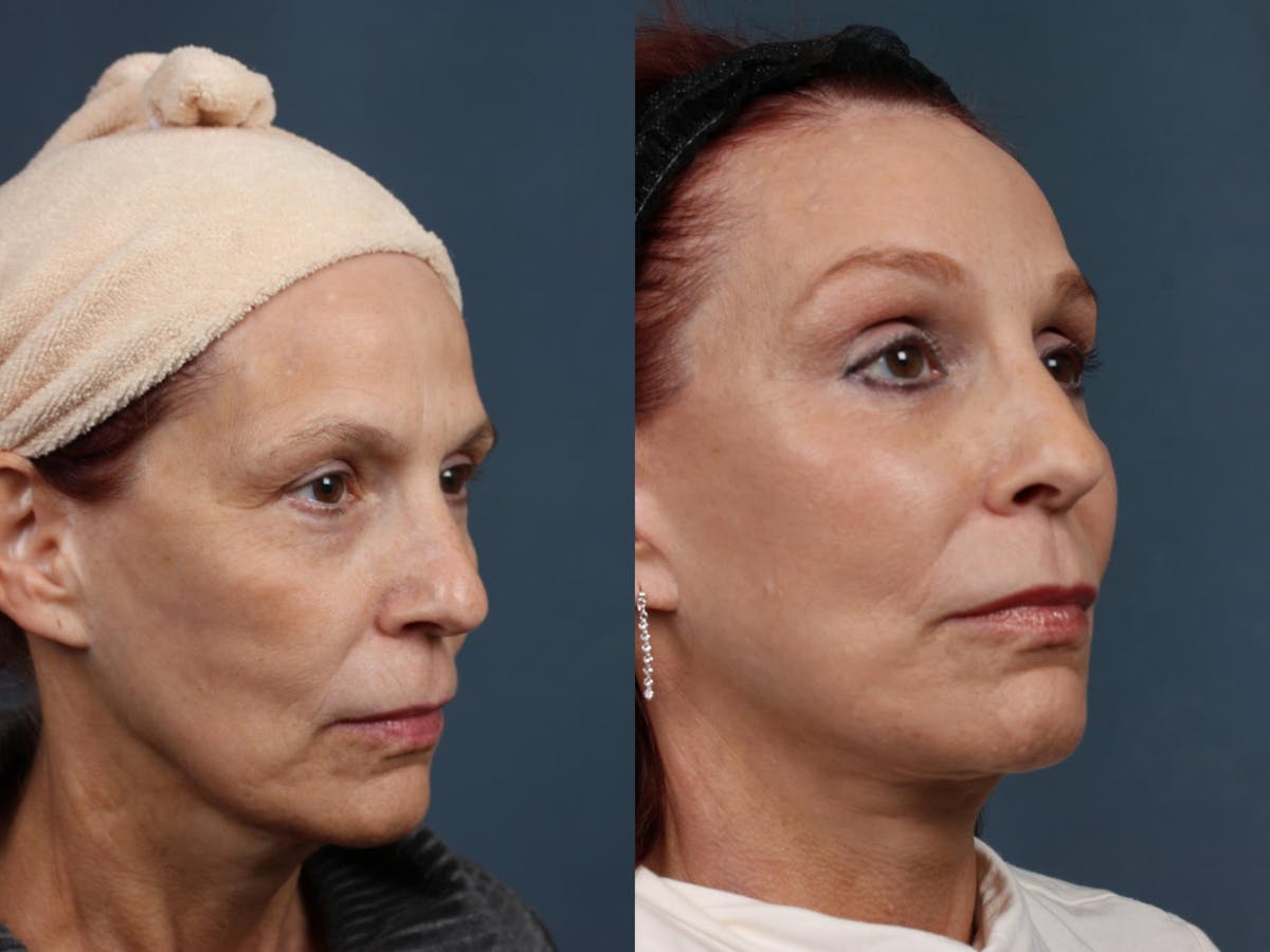 Facelift Before & After Gallery - Patient 390456 - Image 2