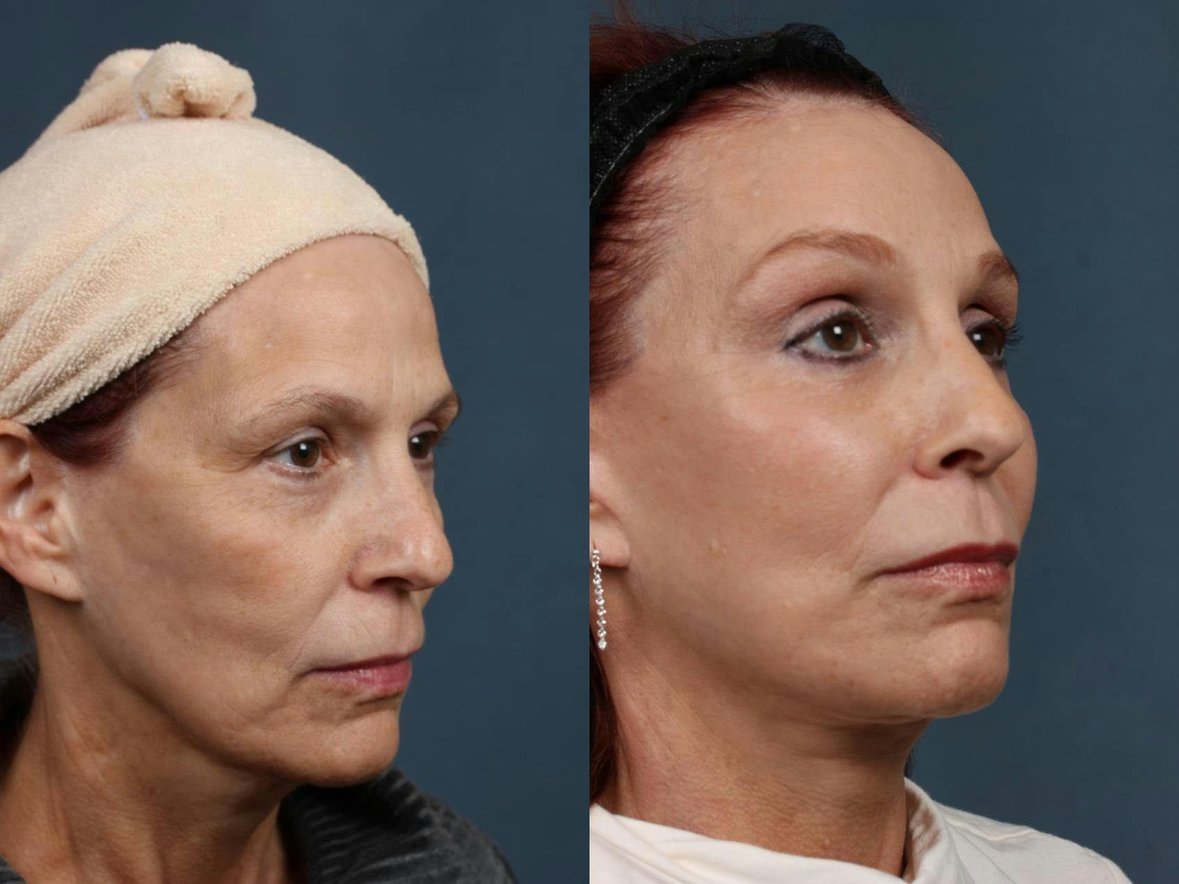 Facelift Before & After Gallery - Patient 390456 - Image 2