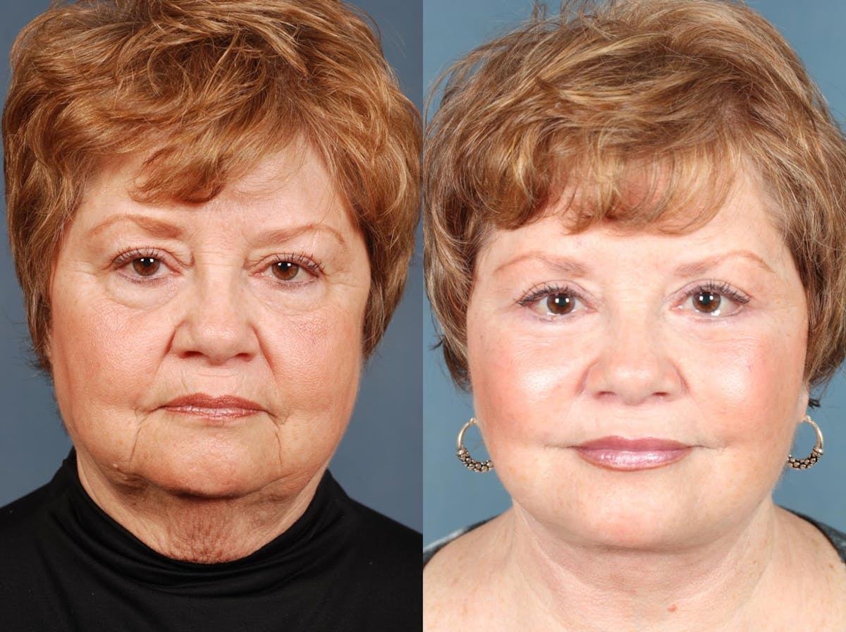 Facelift Before & After Gallery - Patient 105819 - Image 1