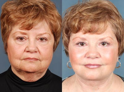 Facelift Before & After Gallery - Patient 105819 - Image 1