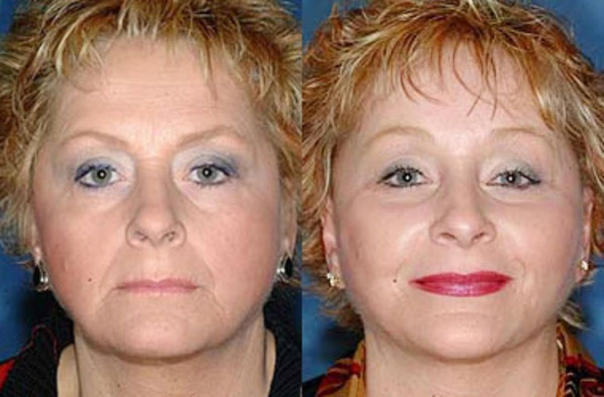 Facelift Before & After Gallery - Patient 156695 - Image 1