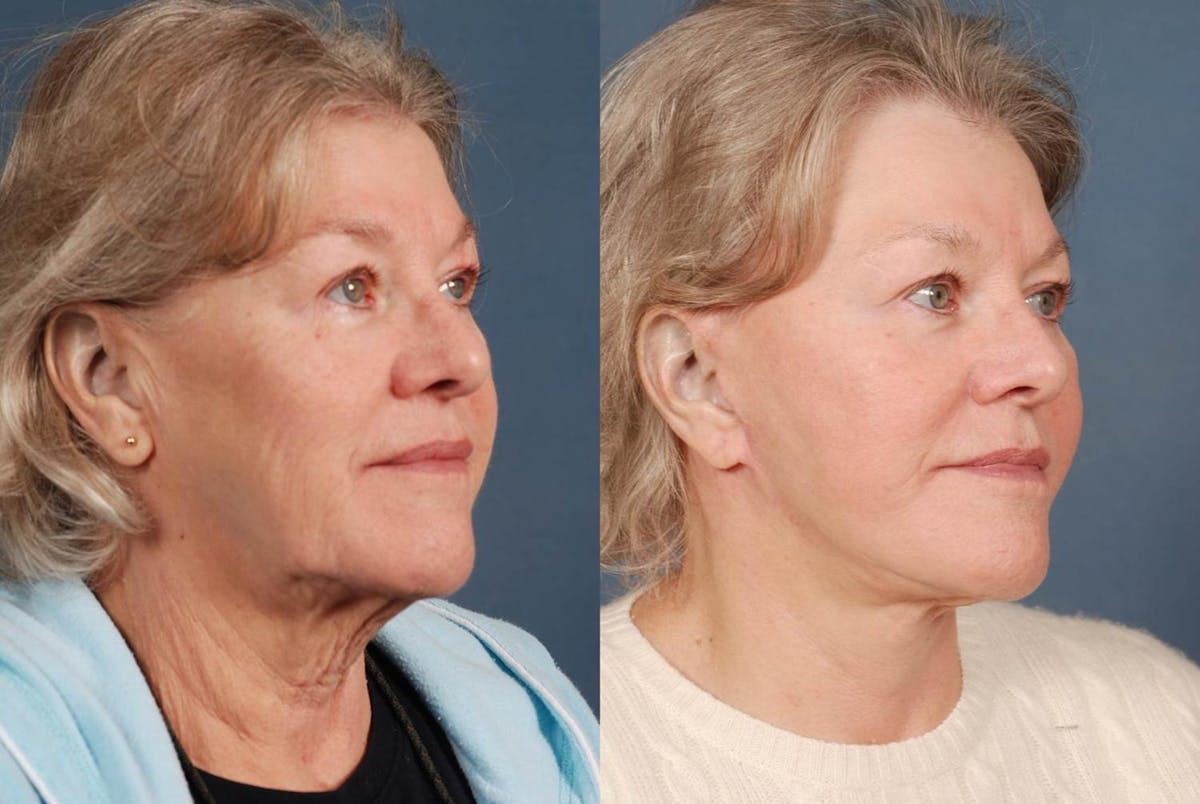 Facelift Before & After Gallery - Patient 245194 - Image 2