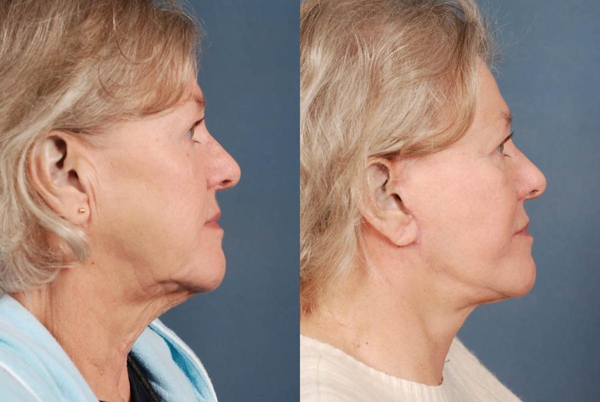 Facelift Before & After Gallery - Patient 245194 - Image 3