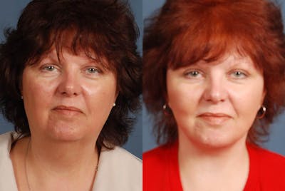 Facelift Before & After Gallery - Patient 365710 - Image 1