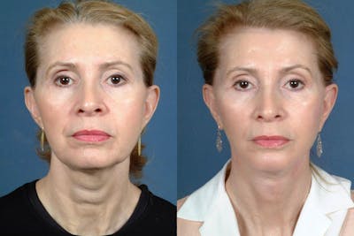 Facelift Before & After Gallery - Patient 396387 - Image 1
