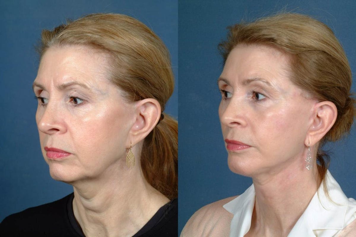 Facelift Before & After Gallery - Patient 396387 - Image 2