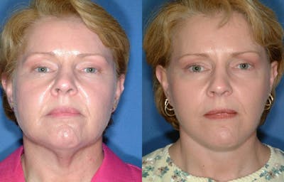 Facelift Before & After Gallery - Patient 135152 - Image 1