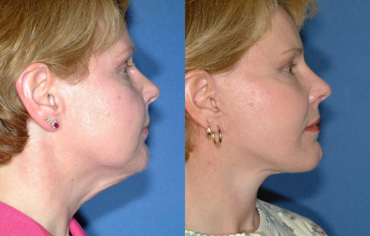 Facelift Before & After Gallery - Patient 135152 - Image 3
