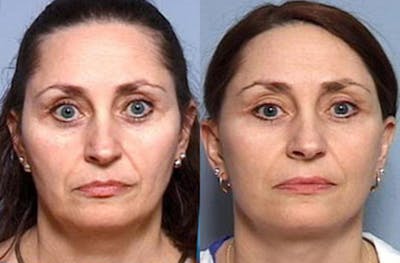 Facelift Before & After Gallery - Patient 367295 - Image 1