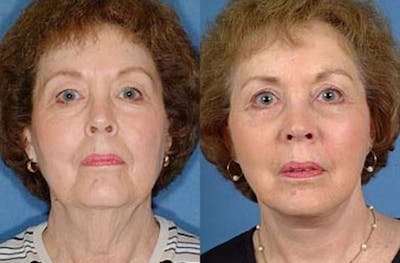 Facelift Before & After Gallery - Patient 237142 - Image 1