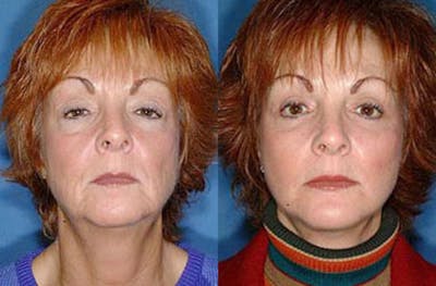 Facelift Before & After Gallery - Patient 337567 - Image 1