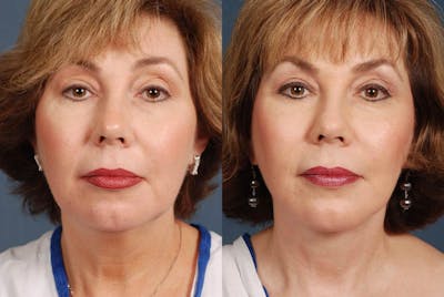 Facelift Before & After Gallery - Patient 258515 - Image 1
