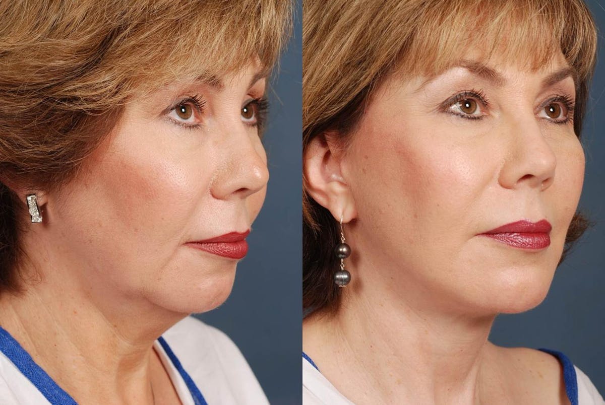 Facelift Before & After Gallery - Patient 258515 - Image 2