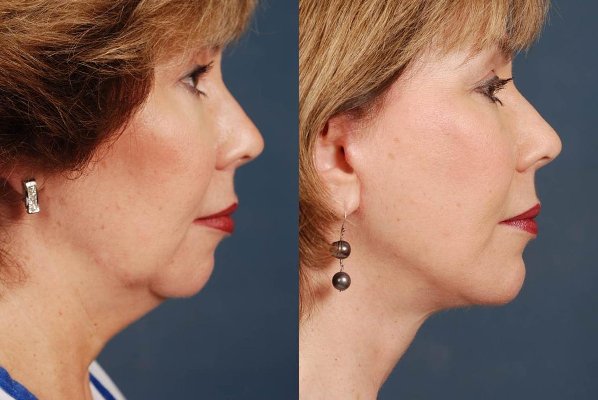 Facelift Before & After Gallery - Patient 258515 - Image 3