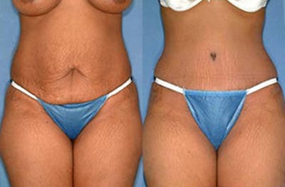 Tummy Tuck Before & After Gallery - Patient 255207 - Image 1