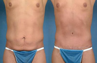 Tummy Tuck Before & After Gallery - Patient 723686 - Image 1