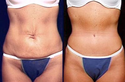 Tummy Tuck Before & After Gallery - Patient 394697 - Image 1