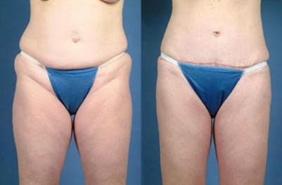 Tummy Tuck Before & After Gallery - Patient 389119 - Image 1