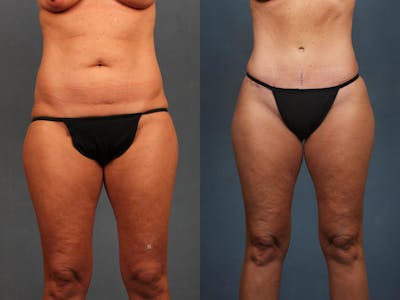 Tummy Tuck Before & After Gallery - Patient 287680 - Image 1