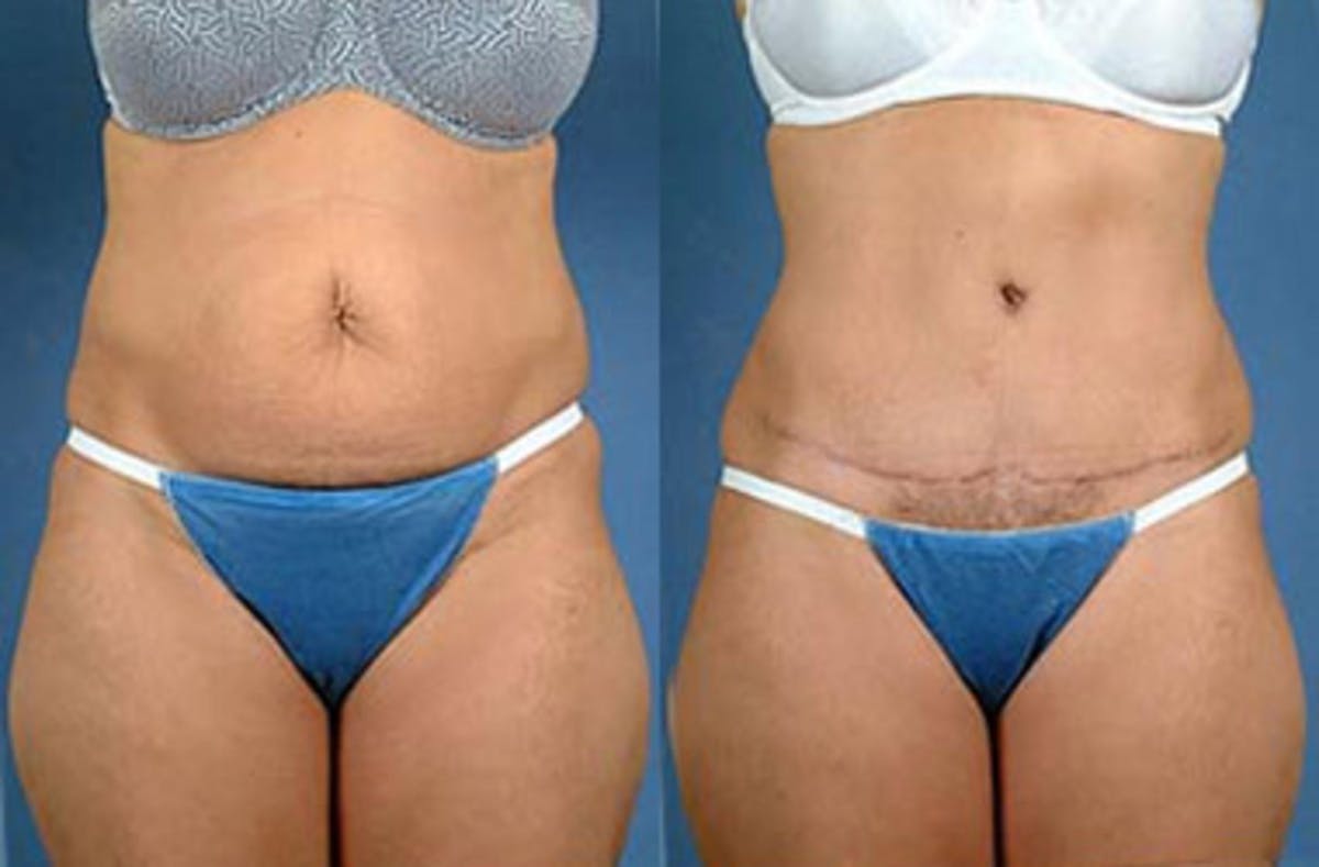 Tummy Tuck Before & After Gallery - Patient 215467 - Image 1
