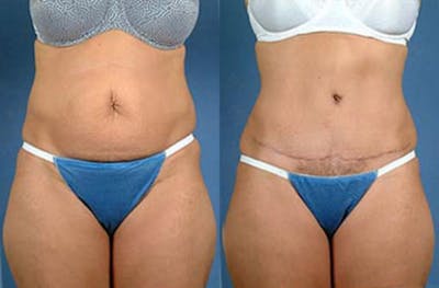 Tummy Tuck Before & After Gallery - Patient 215467 - Image 1