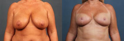 Lift Before & After Gallery - Patient 812132 - Image 1