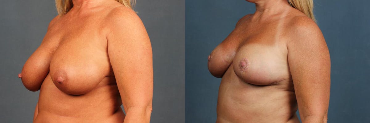 Lift Before & After Gallery - Patient 812132 - Image 2