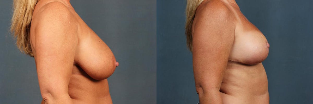 Lift Before & After Gallery - Patient 812132 - Image 5