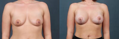 Lift Before & After Gallery - Patient 371544 - Image 1