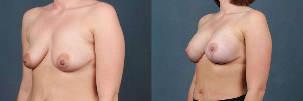 Lift Before & After Gallery - Patient 371544 - Image 2