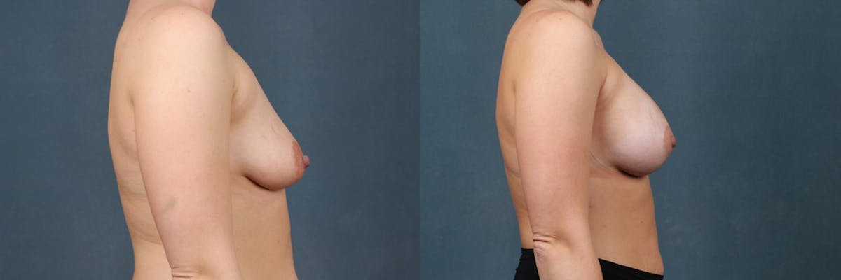 Lift Before & After Gallery - Patient 371544 - Image 3