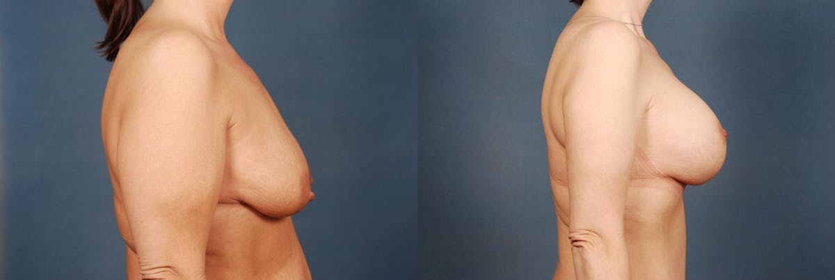 Lift Before & After Gallery - Patient 371620 - Image 3